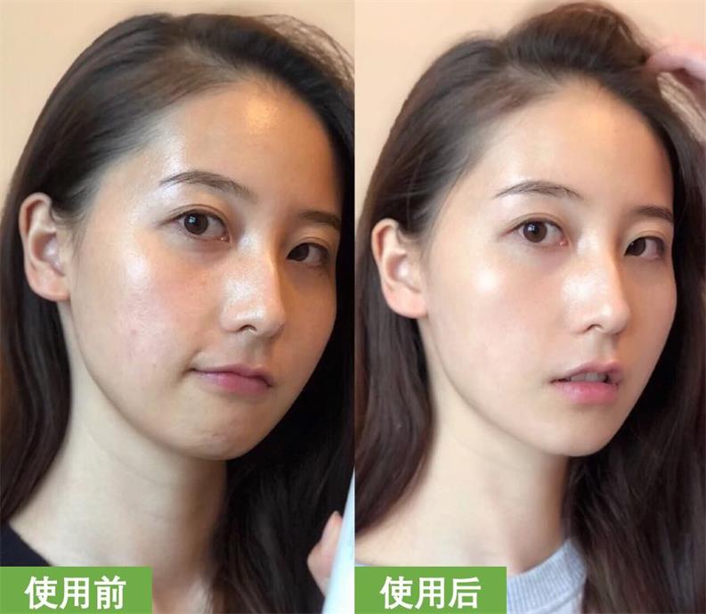 4D HIFU for Face Body Viginal